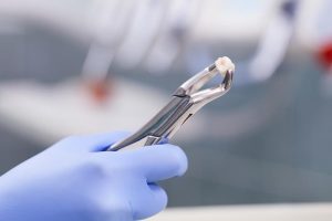 Extractions in Riverside | Riverside Tooth Co. - Dental Riverside